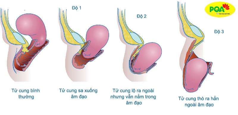 Thật hạnh phúc khi không còn những cơn đau căng tức vùng bụng dưới vì sa tử cung